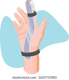 A Zimmer splint for the finger is a medical device used to immobilize and support an injured finger joint by maintaining proper alignment and restricts movement during the healing process.