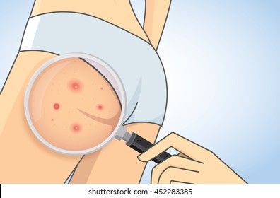 Zoom in acne on buttocks with magnifier. Skin care concept.