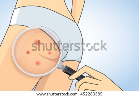 Zoom in acne on buttocks with magnifier. Skin care concept.