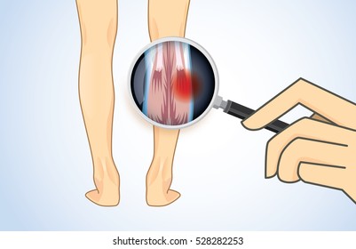 Zoom in Calf Muscle of human with magnifier for check Muscular System. Have a red sign on muscles. Illustration about medical and health care.