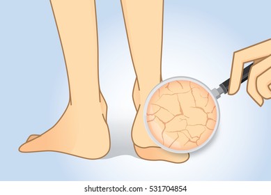 Zoom in cracked heel with magnifier. Illustration about beauty foot skin.
