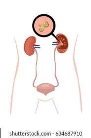 Zoomed In image of Stones being highlighted from a cross section of a Kidney organ. Editable Clip Art.