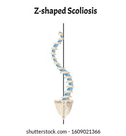 Z-shaped scoliosis. Dextroscoliosis. Levoscoliosis. Spinal curvature, kyphosis, lordosis, scoliosis, arthrosis. Infographics. Vector illustration on isolated background.