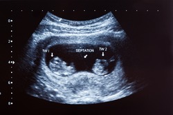 Ultrasound scan of ten months old twin boys