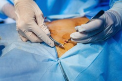 Operation using endoscopy in gynecology