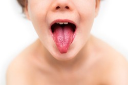 Tongue and mouth of a child during scarlet fever