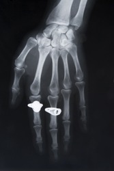 front view of x-ray image of hand with two rings
