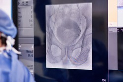 Interventional Radiology. Prostatic artery embolization (PAE)