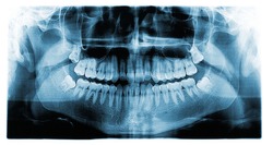 Panoramic dental tooth X-ray of a 17 year old teenage male