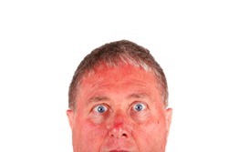 Man with a sunburned face