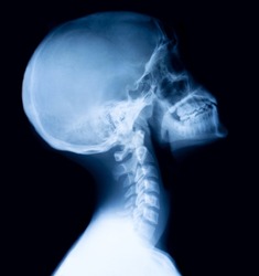 Film x-ray skull and cervical spine lateral view