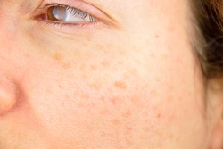 closeup of a woman cheek with liver spot causes by the large exposition sun 
