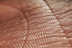 skin psoriasis. Skin diseases concept. macro skin of human hand.Medicine and dermatology concept. Details of human skin background	