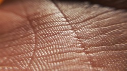 Contact dermatitis. Skin diseases concept. macro skin of human hand.Medicine and dermatology concept. Details of human skin background	