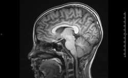 Magnetic resonance image (MRI) of the brain (sagittal view)