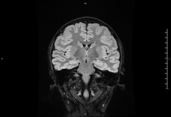 Magnetic resonance image (MRI) of the brain (Coronal view)