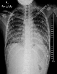 Acute respiratory distress syndrome (ARDS) on Chest X-ray PA upright.
(ARDS is a major cause of death in Patient with COVID-19)
