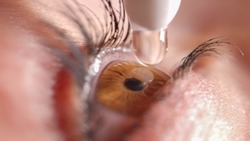MACRO: Shiny clear brown eye twitches before application of eye drops to sooth irritation. Mascara covered lashes flinch when droplet hits eyeball. Female applying water drops to eyeball.
