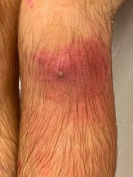 VERTICAL, CLOSE UP: Small cut on a man's knee gets infected and filled with yellow puss. Detailed shot of an adult male's knee as it gets infected and filled with bacteria. Close up of infected limb.