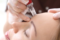 Needle mesotherapy,Microneedle mesotherapy, treatment woman at the beautician