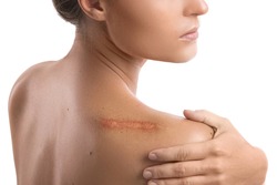 Woman with a scar on her shoulder over white background