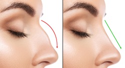 Comparison of Female nose after plastic surgery