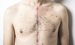 Scar from open heart surgery, where the sternum was cut in two, and the rib cage sprung. Below the scar holes show where the drains and pacemaker cables emerged. Image taken 24 days following surgery