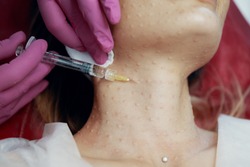 Beautician doctor with botulinum toxin syringe making injection to platysmas bands.Neck rejuvenation mesotherapy.Anti-aging treatment and face lift in cosmetology clinic.Patient lying on chair.
