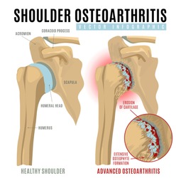 Shoulder osteoarthritis infographic. Realistic bones scheme. Joint pain. Editable vector illustration isolated on a white background. Medical, healthcare, elderly diseases graphic concept