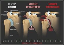 Shoulder osteoarthritis infographic. Realistic bones scheme. Joint pain. Editable vector illustration isolated on a dark grey background. Medical, healthcare, elderly diseases graphic concept