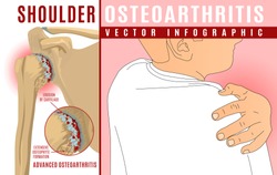 Advanced shoulder osteoarthritis infographic. Realistic bones scheme. Joint pain. Editable vector illustration with a man figure. Medical, healthcare, common diseases concept. Horizontal poster