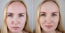 Photos before and after mesotherapy, biorevitalization, botulinum toxin injections. Skin fold between eyebrows, forehead wrinkles. At the appointment with a plastic surgeon or cosmetologist