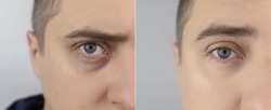 Before and after. Bags under eyes, hernias on the man face. Patient being examined by a plastic surgeon. Before and after blepharoplasty. Puffiness, skin folds and varicose veins in the eyelids