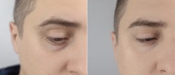 Before and after. Bags under eyes, hernias on the man face. Patient being examined by a plastic surgeon. Before and after blepharoplasty. Puffiness, skin folds and varicose veins in the eyelids