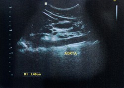 Aorta Ultrasound - Scan medical imaging of abdomen showed aorta.
