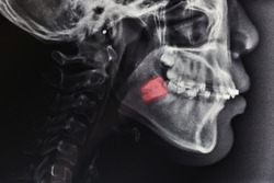 panoramic xray image of red color teeth, patient of tooth, problem with tooth, healthcare concept background.