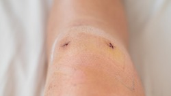 Close-up of a surgical suture on the knee after laparoscopic meniscus surgery.