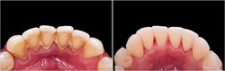 teeth cleaning and whitening before and after picture