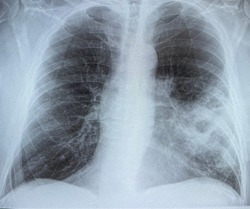 The chest radiography of an elderly man who has severe pneumonia at left side of the lung. 