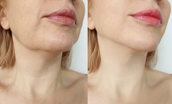 female double chin   after correction