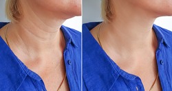 woman neck wrinkles   after treatment