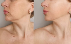 woman double chin   after treatment