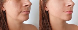 woman double chin   after treatment
