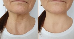 woman neck wrinkles before and after treatment