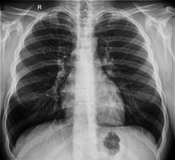 Radiography x-ray film of human chest lungs
