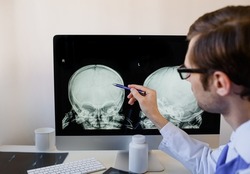 Man radiologist analyzing a child skull x ray with left parietal bone fracture. Child abuse 