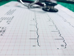 Stethoscope and heart ekg cardiogram of wave in paper report analysis. Medical and healthcare concept.