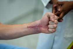 Scars on the skin of the man arm after surgery while the patient is still in the hospital. Scar with stitches on the wrist after surgery.