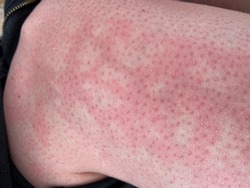 mottled skin heat rash hives allergy reaction on knee close-up reference picture of blotchy mottled red skin erythema ab igne also known as EAI this can also happen at end of life death situations 
