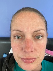 face of a woman with hyper-pigmentation melasma of rare Addison's disease, also known as primary adrenal insufficiency or hypoadrenalism, is a rare disorder of the adrenal glands. known as bronzing 
